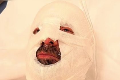 « J&rsquo;ai fait l&rsquo;erreur bête » : un maire brûlé au visage et à la main après un violent retour de flamme