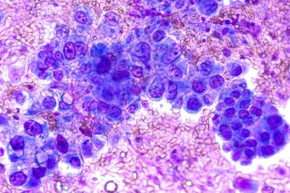 Les réserves de sucre dans l&rsquo;organisme peuvent alimenter la progression du cancer du poumon