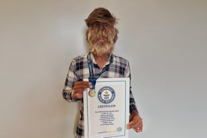 « Syndrome du loup-garou » : un jeune de 18 ans décroche le record du visage le plus poilu du monde