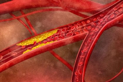 Les médicaments hypocholestérolémiants peuvent affecter la santé