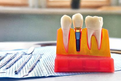 Avoir des dents en moins peut avoir de lourdes conséquences : quand et comment restaurer le sourire