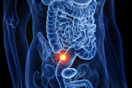 Les taux de cancer de l&rsquo;appendice quadruplent chez les milléniaux plus âgés, les signes passant souvent inaperçus