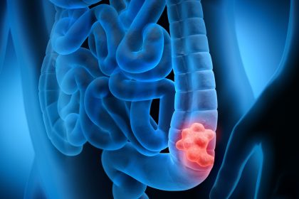 Coloscopie : les résultats inattendus d’une étude majeure, vaut-elle la peine d’être effectuée ?