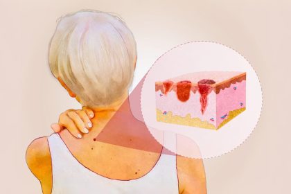 Cancer de la peau : les signes avant-coureurs à surveiller