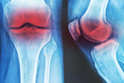 Trois thérapies non-médicamenteuses pour l&rsquo;arthrose du genou