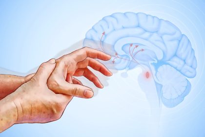 La maladie de Parkinson : deuxième trouble neurodégénératif le plus courant et ses premiers signes