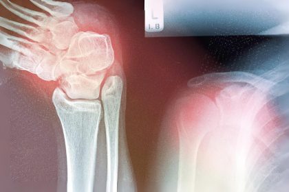 Pourquoi les troubles musculo-squelettiques augmentent – et comment s&rsquo;attaquer aux causes profondes