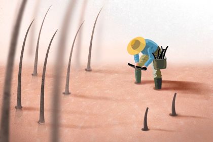 La dernière chance contre la calvitie ?