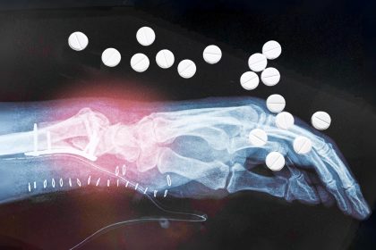 Fractures : l’effet surprise du traitement hormonal