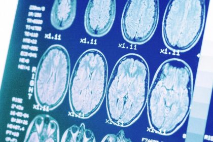 Hypertension : un risque accru d’Alzheimer