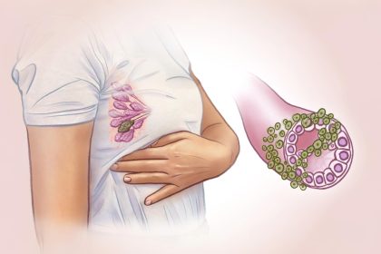 Cancer du sein : un des cancers les plus fréquents chez les femmes – Les signes précoces à connaître