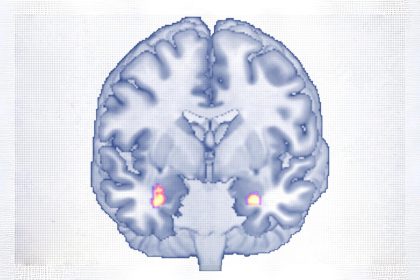 La thérapie cognitivo-comportementale remodèle la structure du cerveau