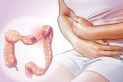 Syndrome de l’intestin irritable : symptômes clés à surveiller