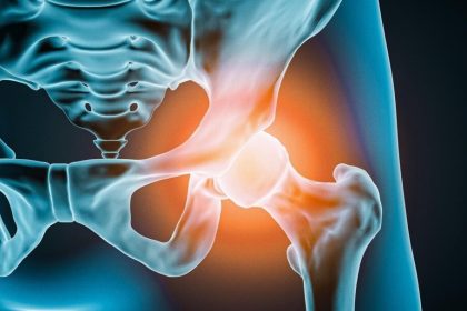Prothèse de hanche : comment savoir quand il est temps de se faire opérer