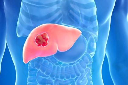 Cancer du foie : jusqu’à 60 % des cas pourraient être évités — voici comment »