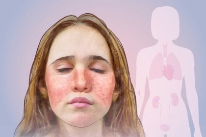Lupus : comment reconnaître les signes de cette maladie imprévisible qui peut toucher tout l’organisme