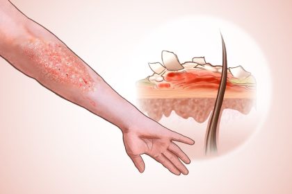 Psoriasis : cinq approches de mode de vie pour mieux vivre avec cette maladie auto-immune