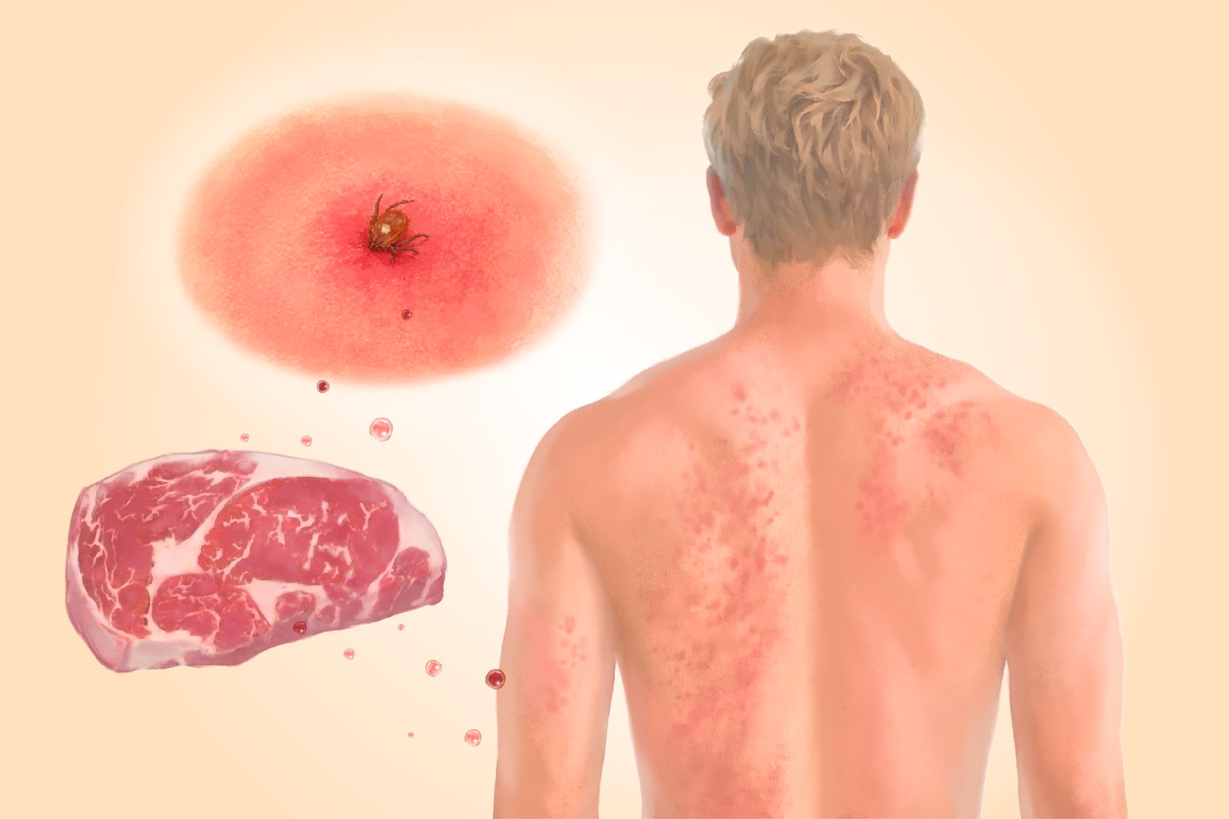 Le syndrome de l’alpha-gal-Comment une piqûre de tique déclenche une sensibilité à la viande — voici les causes