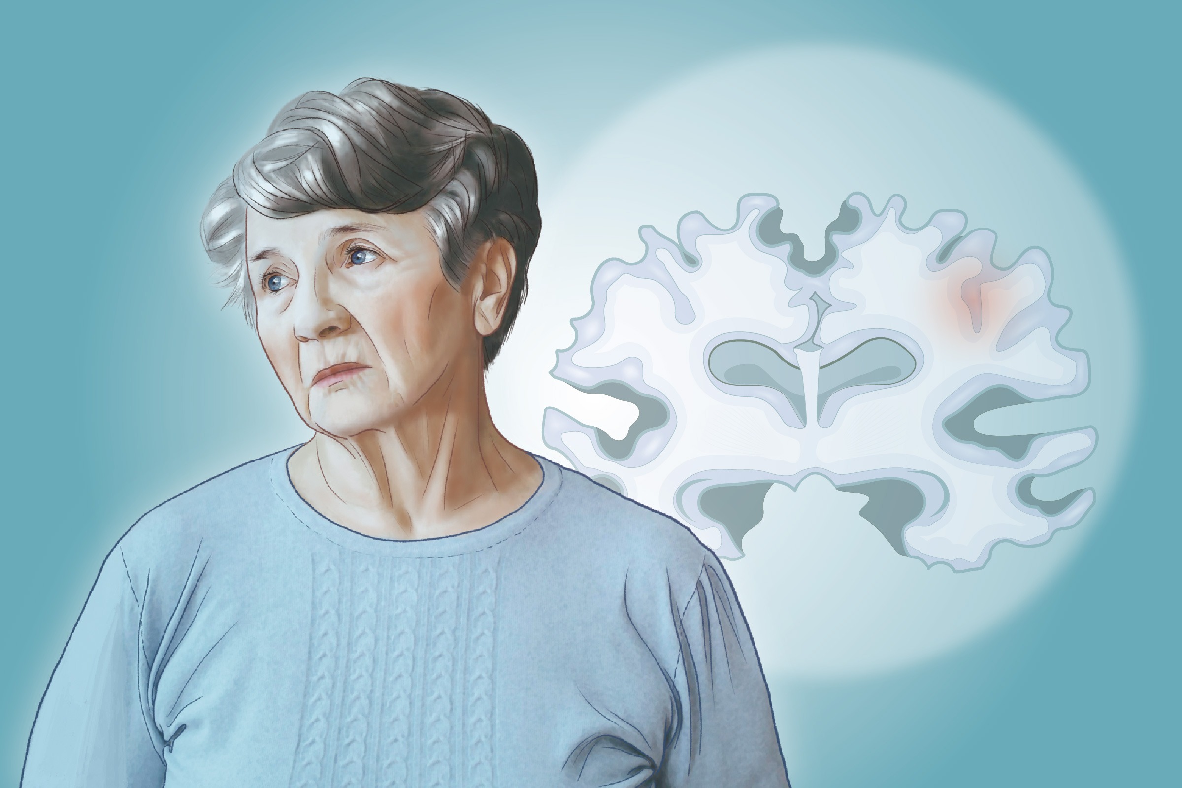 Maladie d’Alzheimer : les causes de la maladie neurodégénérative la plus fréquente