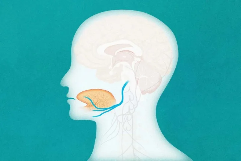 Stimulation du nerf hypoglosse contre l’apnée du sommeil